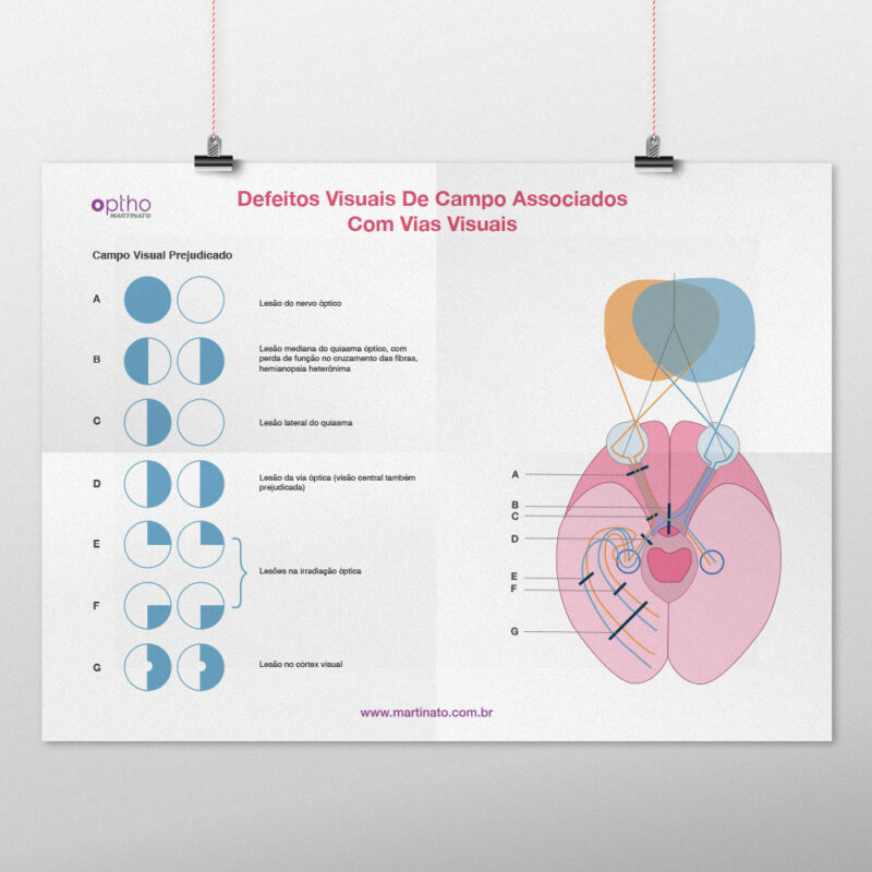 defeitos visuais martinato