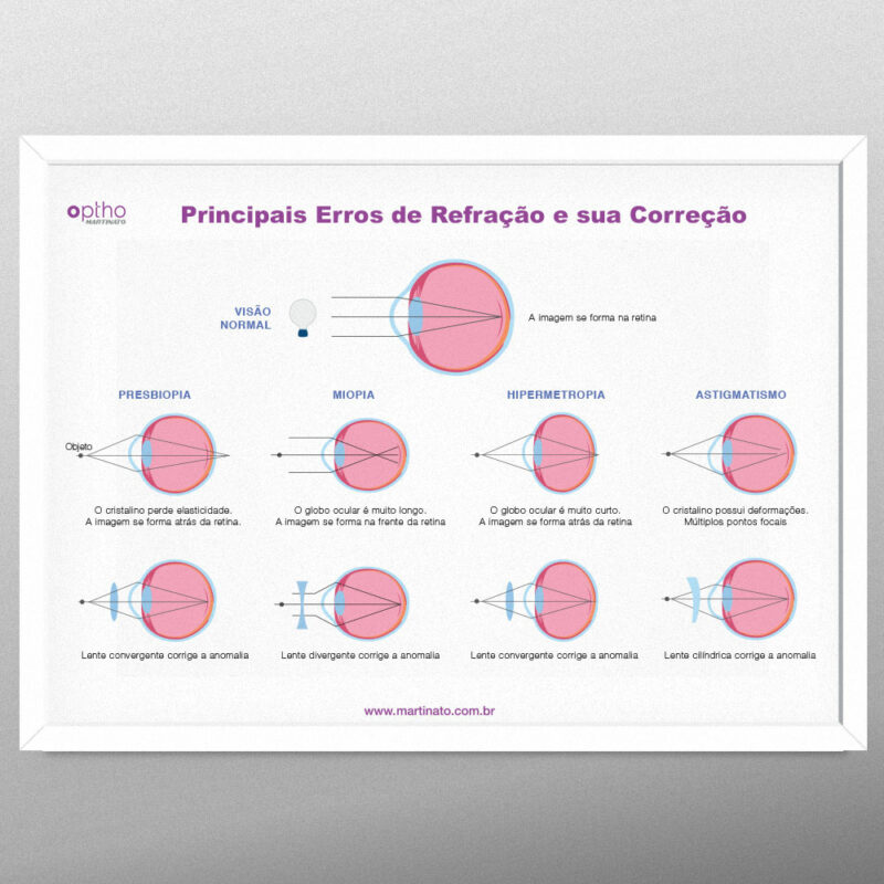 erros de refração martinato