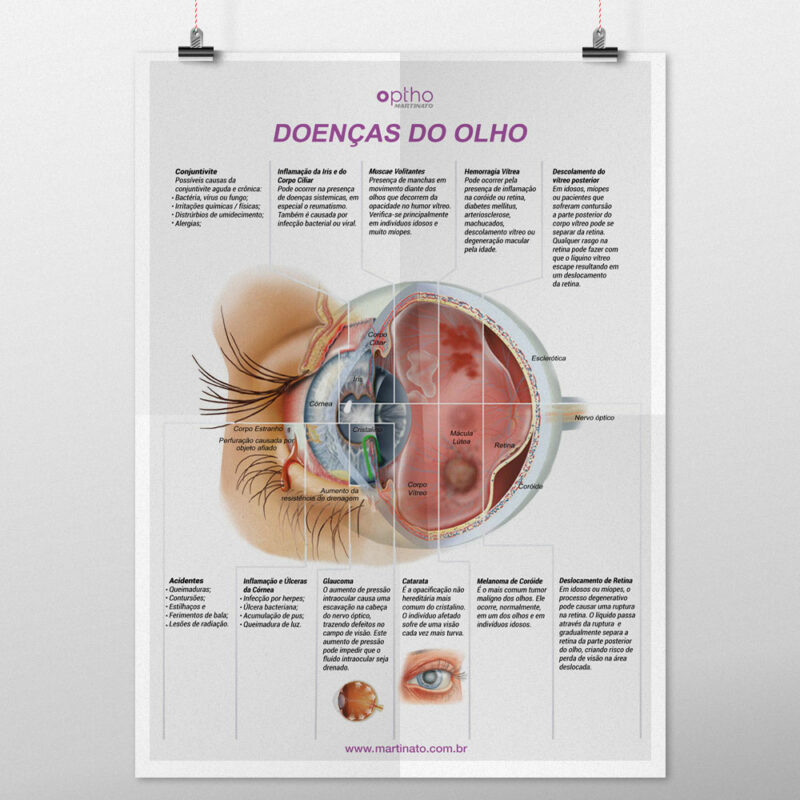 Doenças-do-Olho-martinato