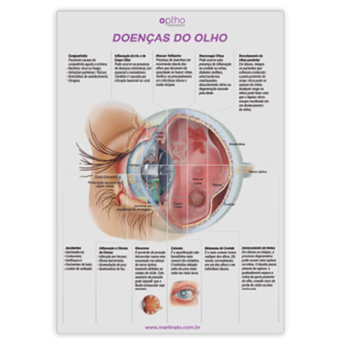 Poster doencas do olho martinato