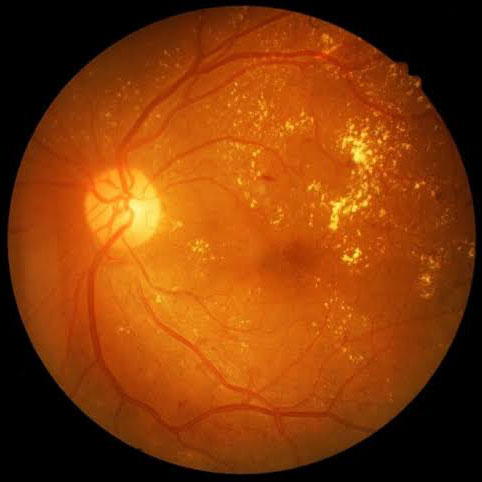 retinopatia-diabetica