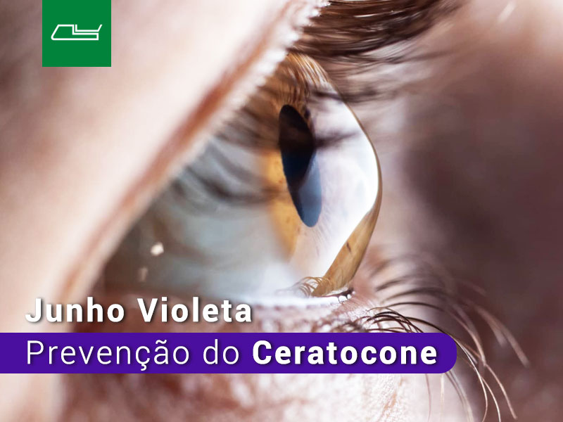 Read more about the article Ceratocone
